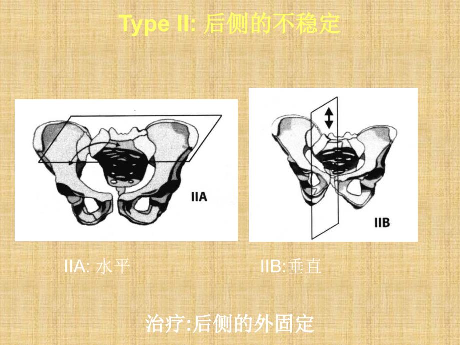 骨盆型外固定架精编版_第4页