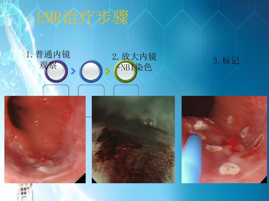 和治疗消化道早癌探素课件ppt_第4页