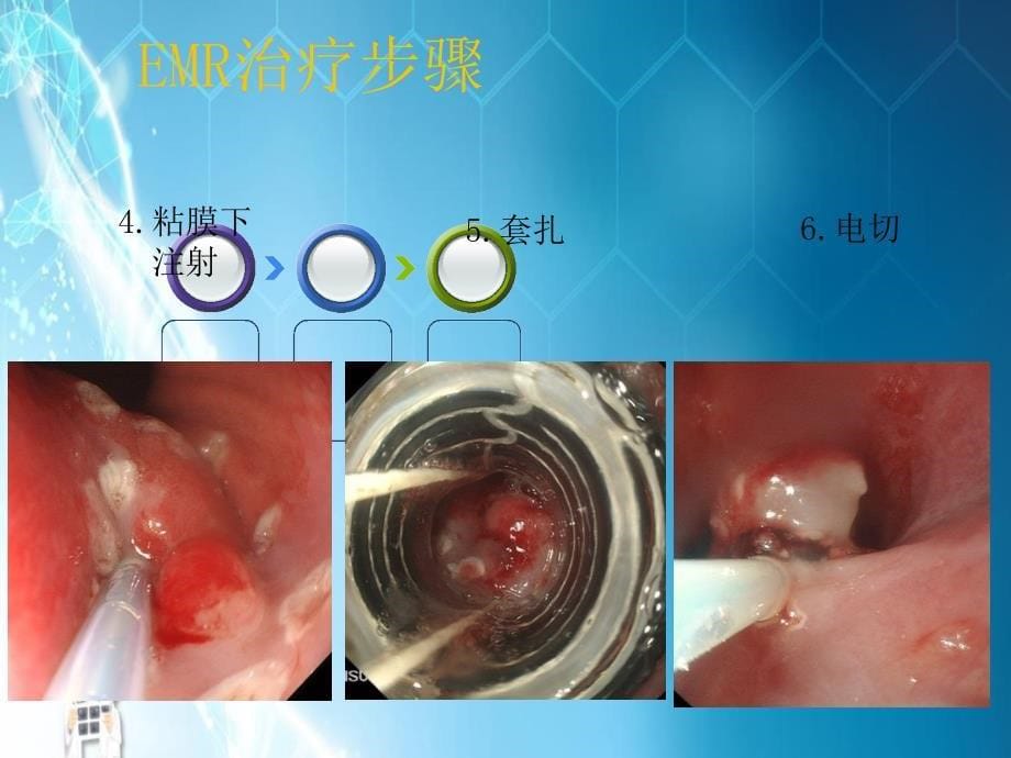 和治疗消化道早癌探素课件ppt_第5页