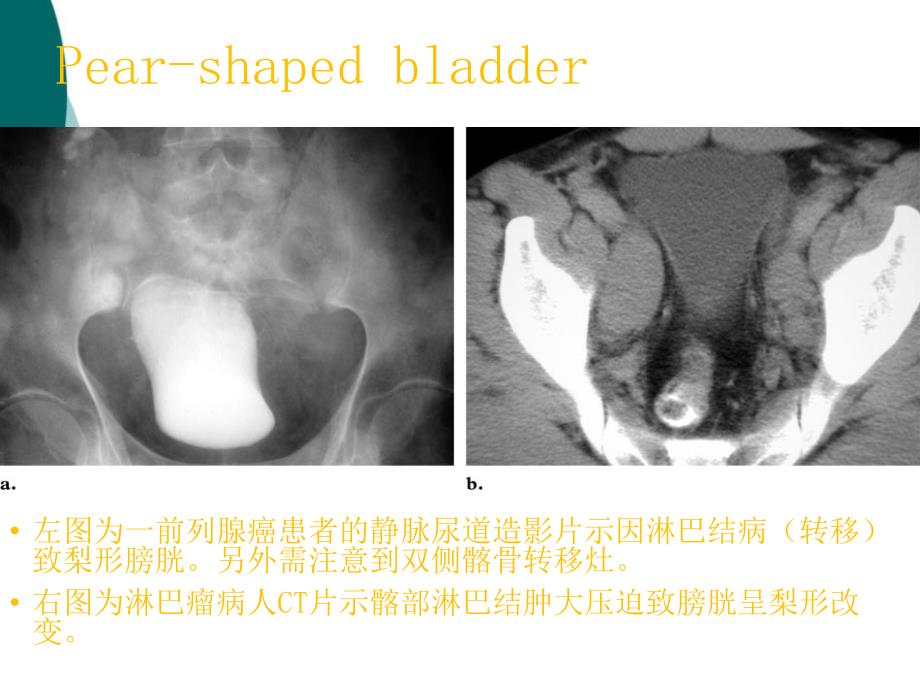 自助餐的影像征象课件ppt_第4页