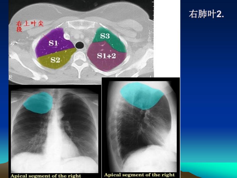 肺CT正常彩色解剖图-肺(简好)精编版_第3页