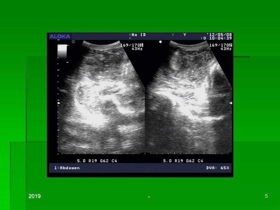 右侧腋窝实质性肿块的超声诊断及鉴别诊断ppt课件_第5页