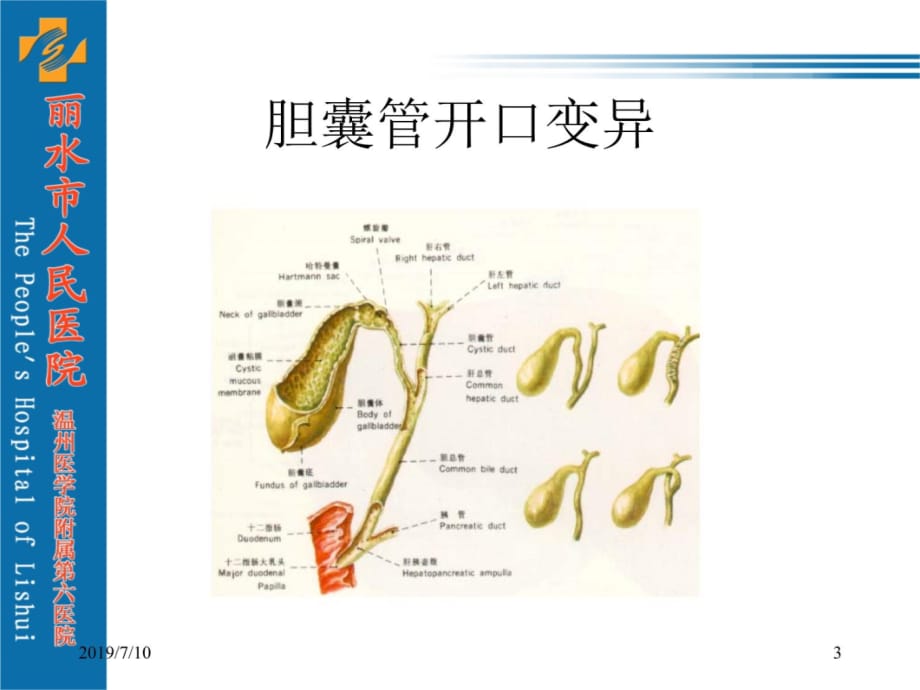 胆囊结石及其防治.教学文案_第3页