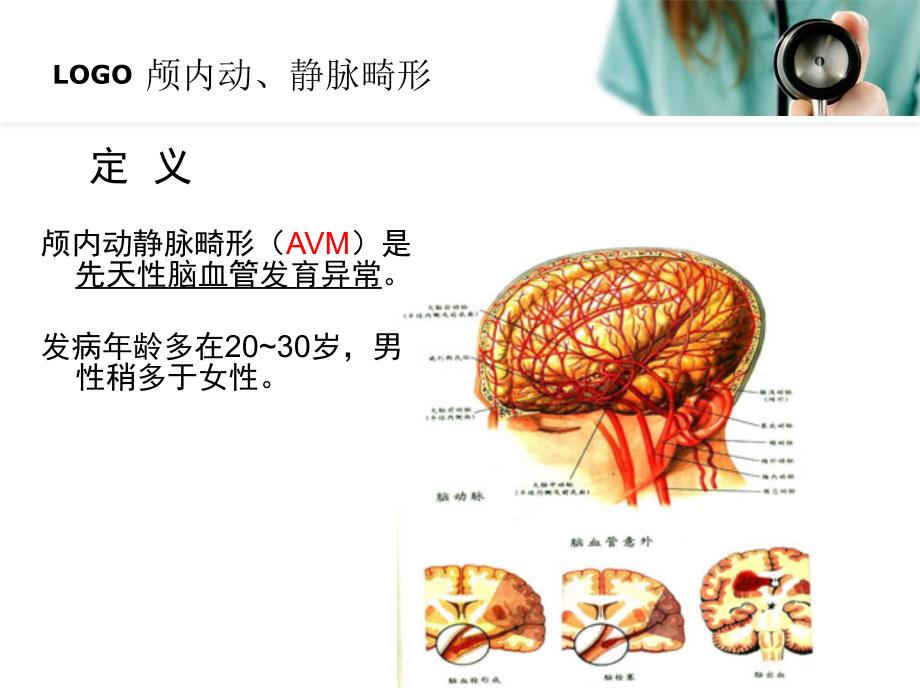 钟欢脑血管畸形精品讲稿ppt课件_第3页