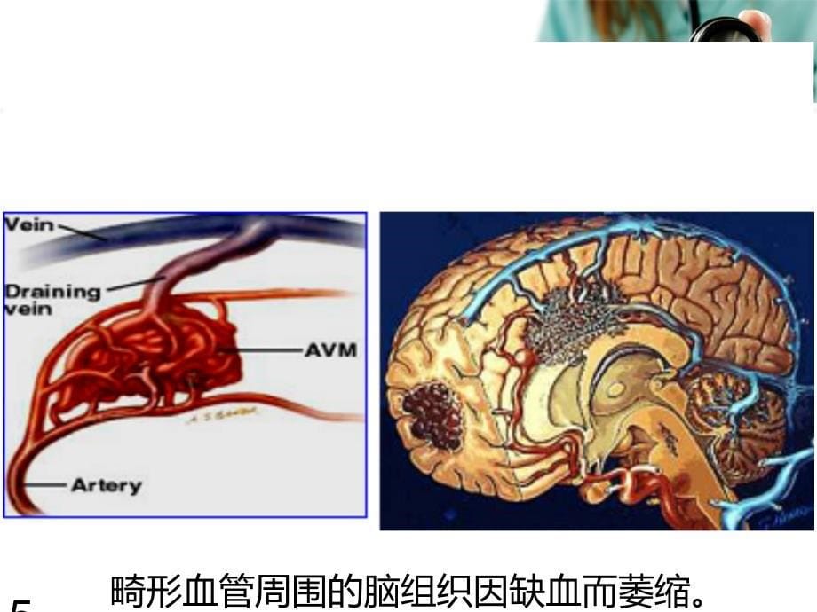 钟欢脑血管畸形精品讲稿ppt课件_第5页