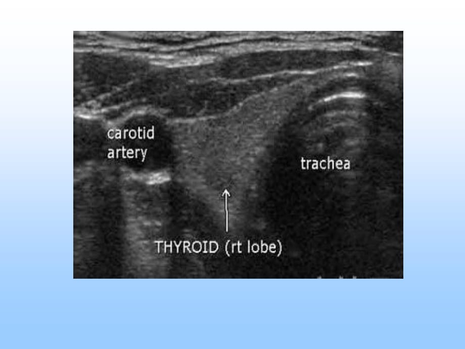 甲状腺疾病超声诊断修改—临床医生如何阅读甲状腺疾病超声检查报告单修改后讲课用ppt课件_第3页