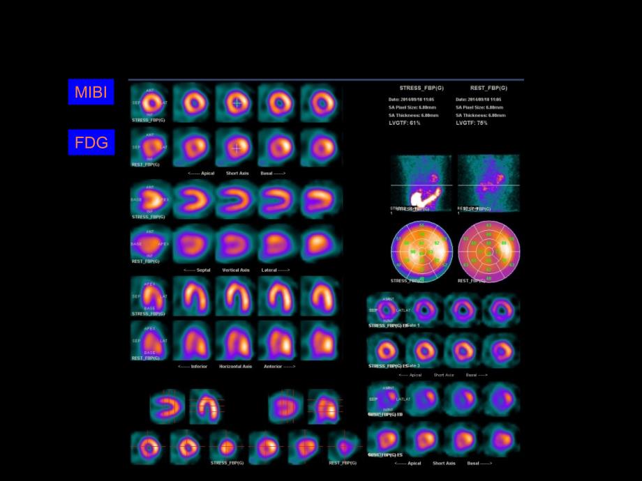 核医学病例读片ppt课件_第4页