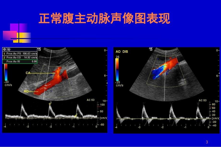 腹膜后大血管超声ppt课件_第3页