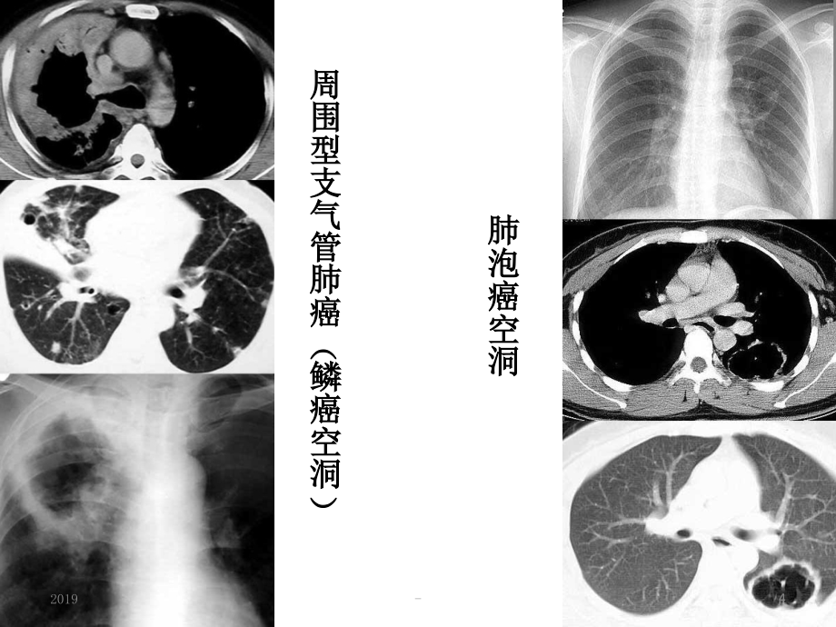 肺部空洞样病灶的影像诊断ppt课件_第4页