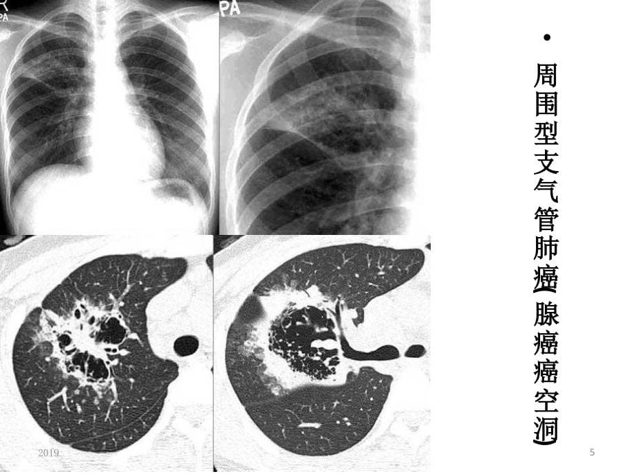 肺部空洞样病灶的影像诊断ppt课件_第5页