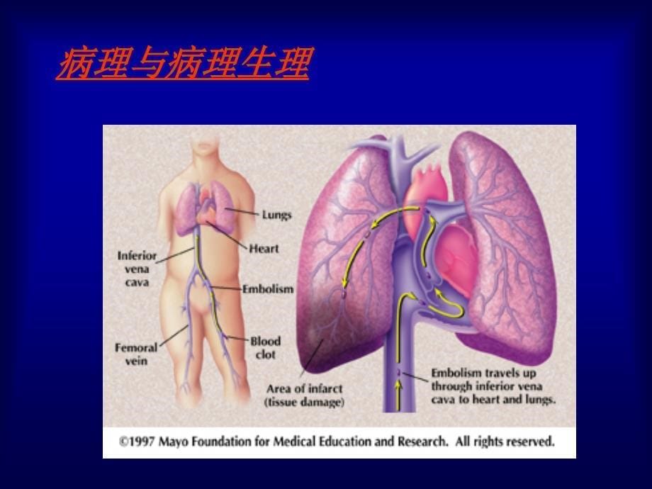 肺血栓栓塞症的诊断与治疗整理.ppt_第5页