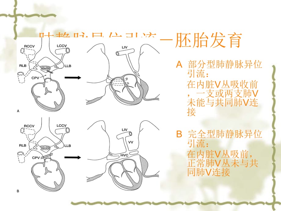 肺静脉异位引流修改ppt课件_第4页