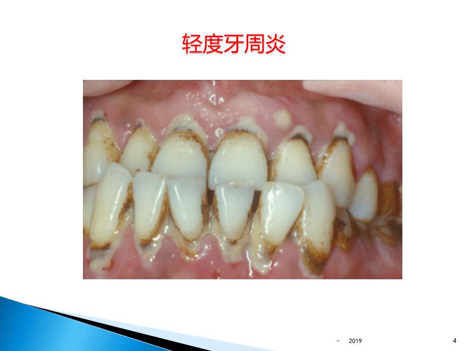 牙龈卟啉单胞菌ppt课件_第4页