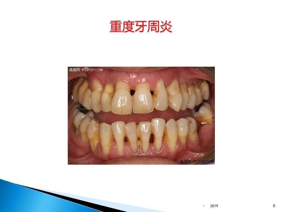 牙龈卟啉单胞菌ppt课件_第5页