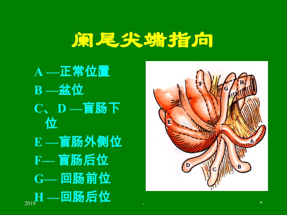 第二十二章阑尾炎ppt课件_第4页