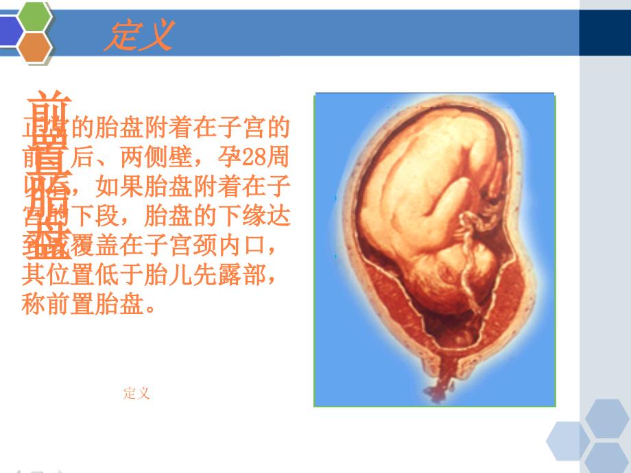 九、前置胎盘ppt课件_第3页