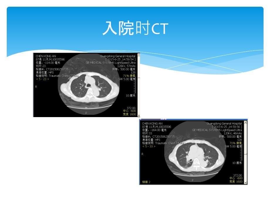 感染性心内膜炎病例讨论知识讲解_第5页