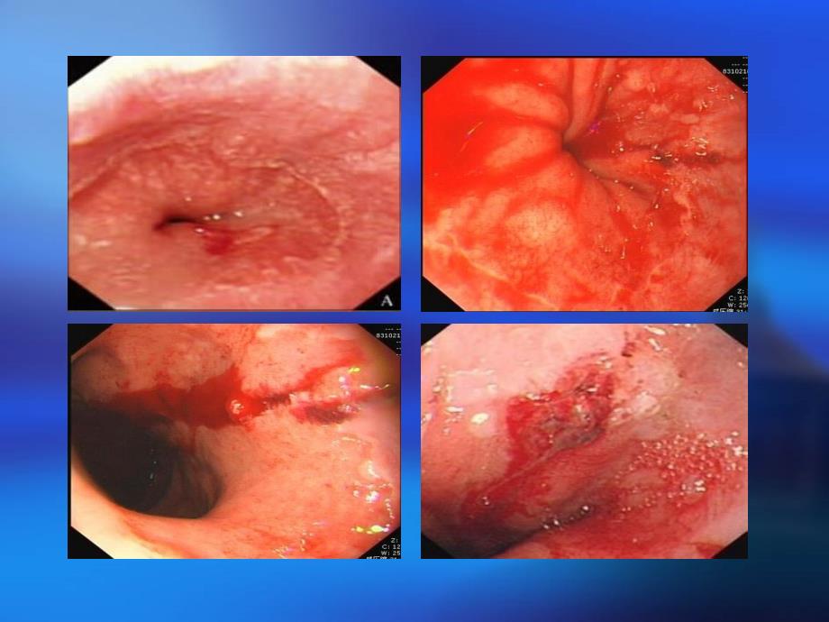 贲门粘膜撕裂课件ppt课件_第3页