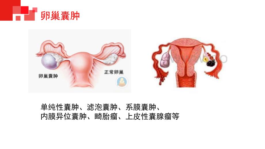 腹腔镜下卵巢囊肿剥除术配合备课讲稿_第4页