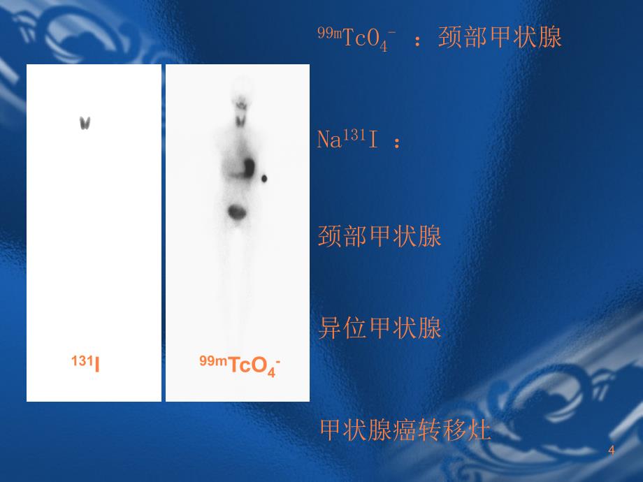 甲状腺相关核医学检查ppt课件_第4页