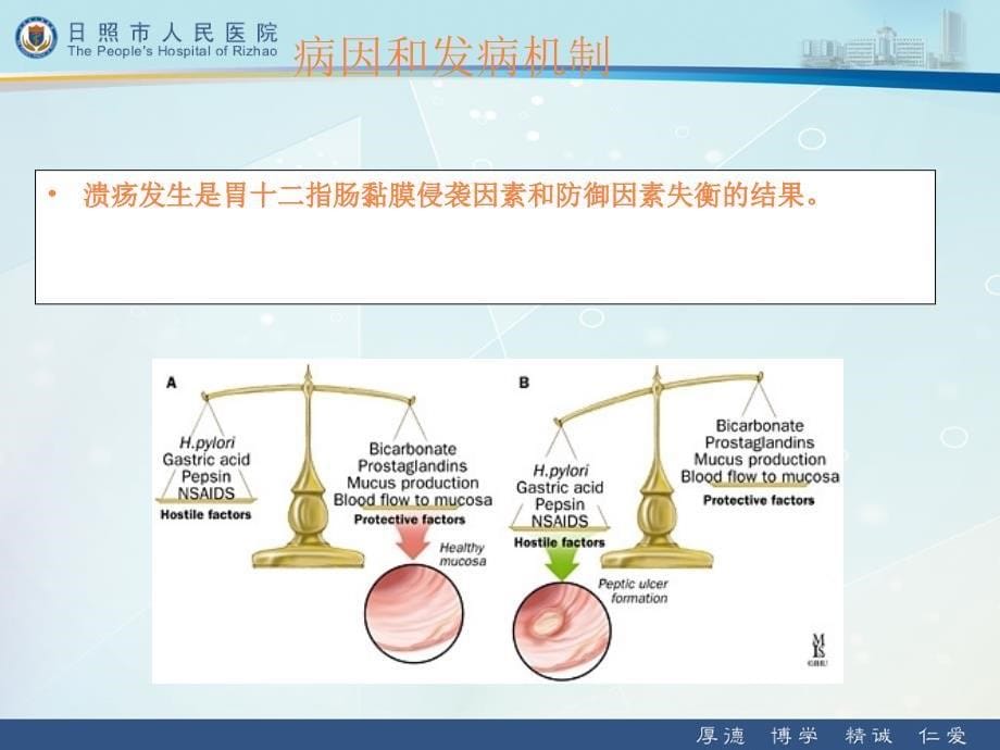 第八版消化性溃疡课件ppt课件_第5页