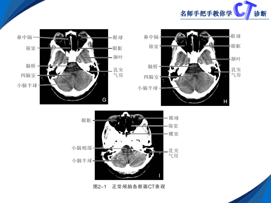 第二章颅脑PPT课件_第4页