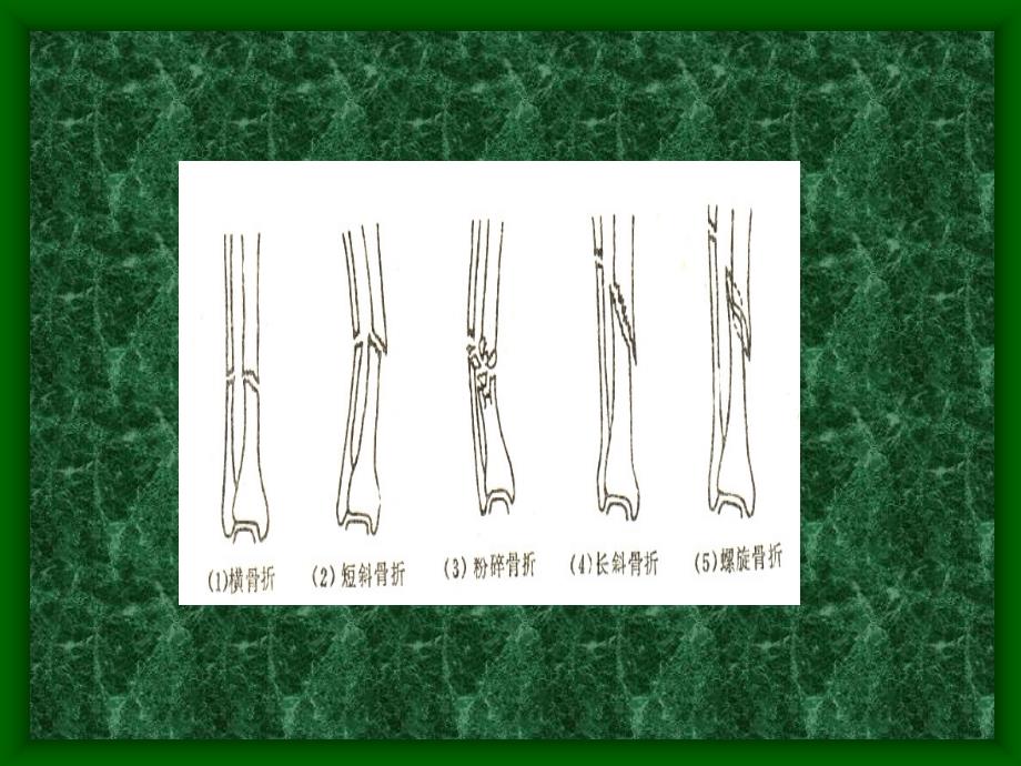 胫腓骨骨折课件PPT课件_第4页