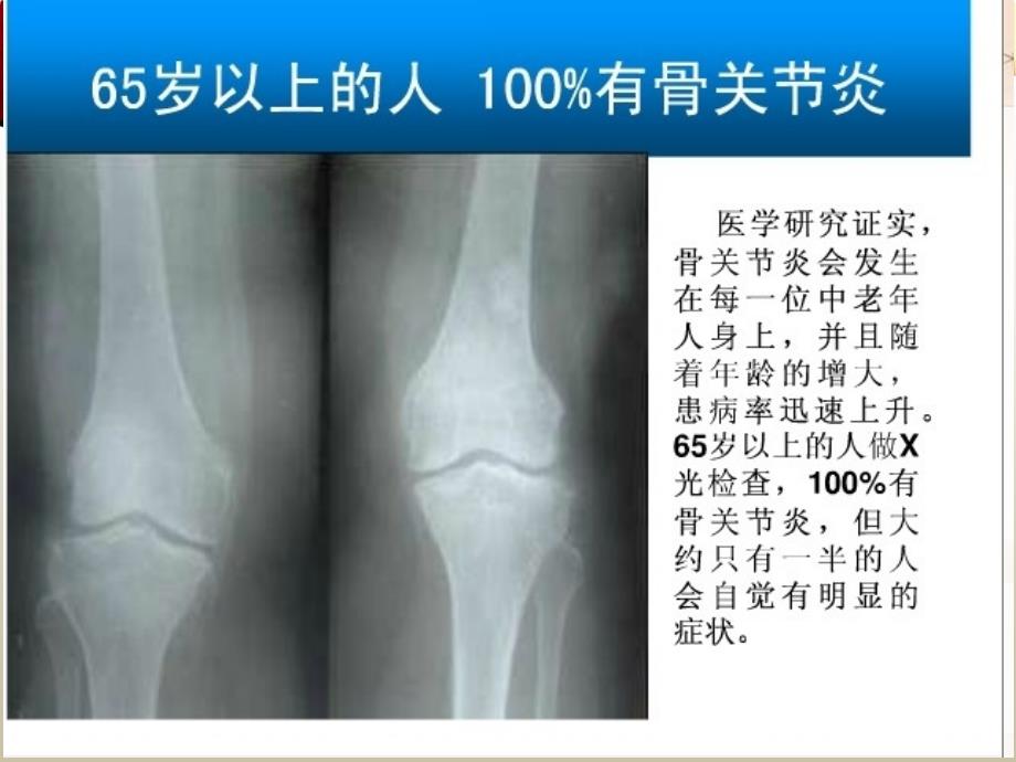 骨关节疾病与骨安PPT课件_第3页