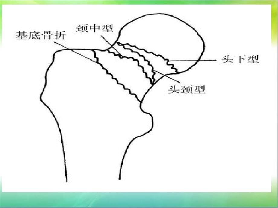 髋关节置换术的护理PPT课件_第5页