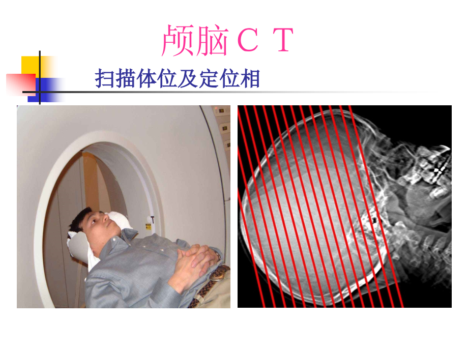 颅脑CT诊断1PPT课件_第2页