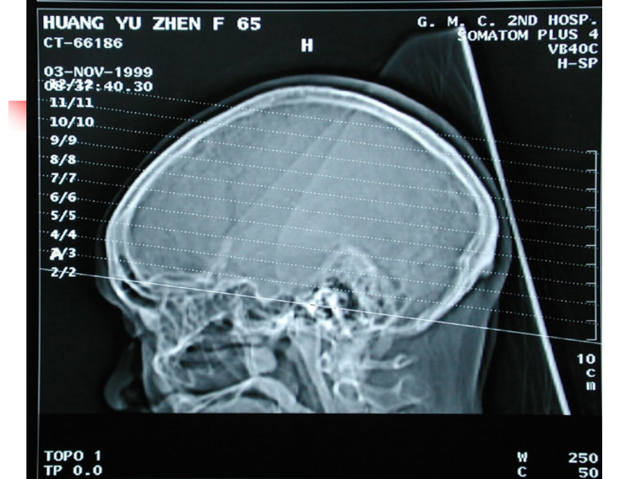 颅脑CT诊断1PPT课件_第4页