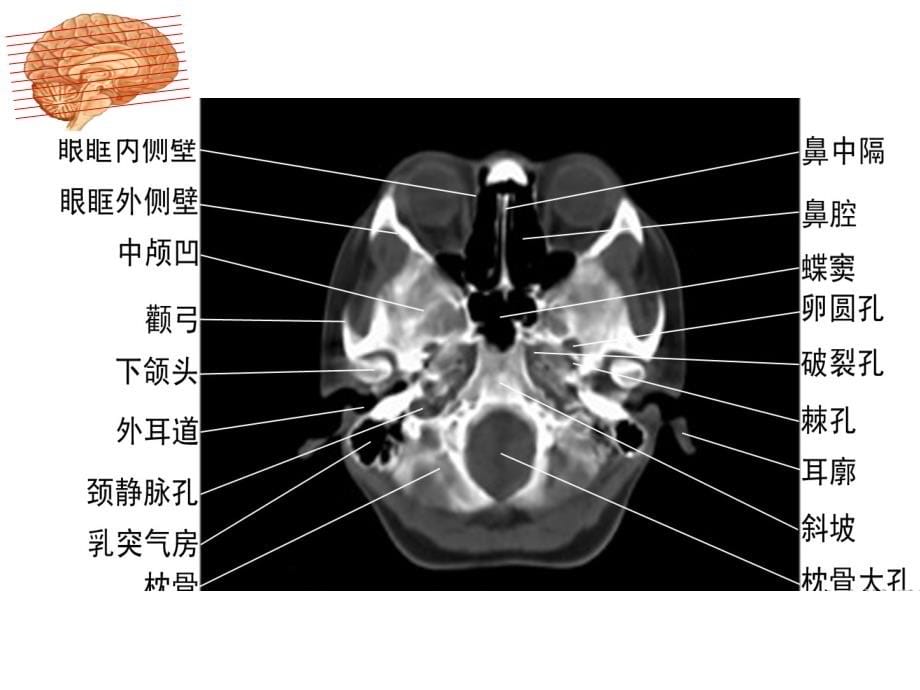 颅脑CT诊断1PPT课件_第5页