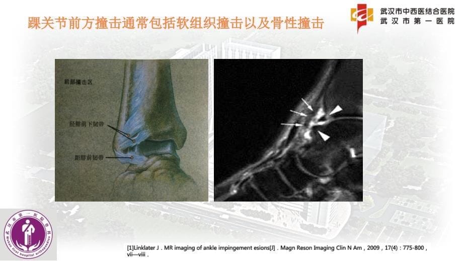 踝关节前方骨性撞击PPT课件_第5页