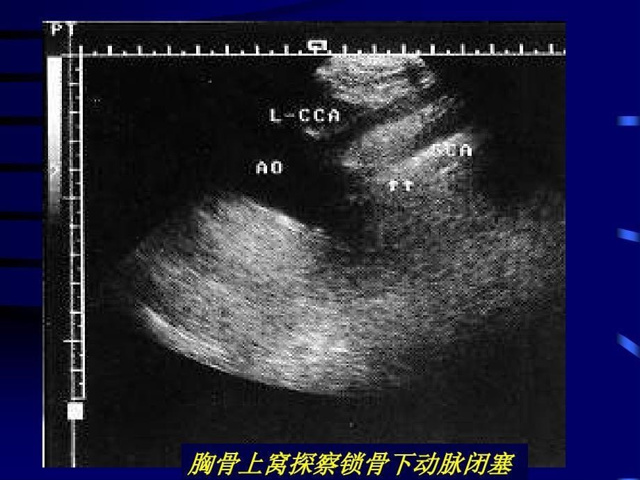 周围血管疾病多普勒超声检查第四部分PPT课件_第5页