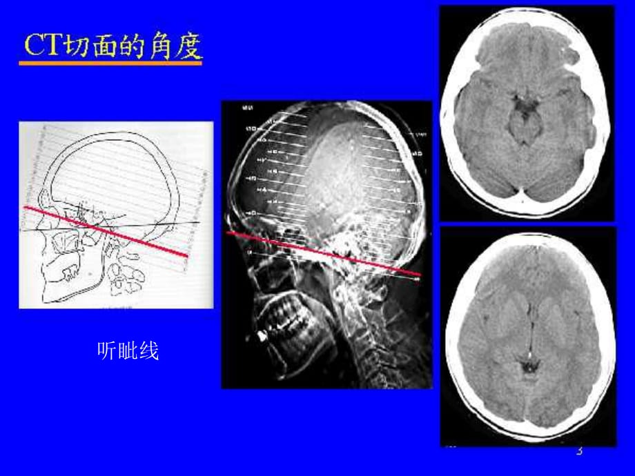 《精编》颅脑CT的基本概念与中风的CT诊断_第4页