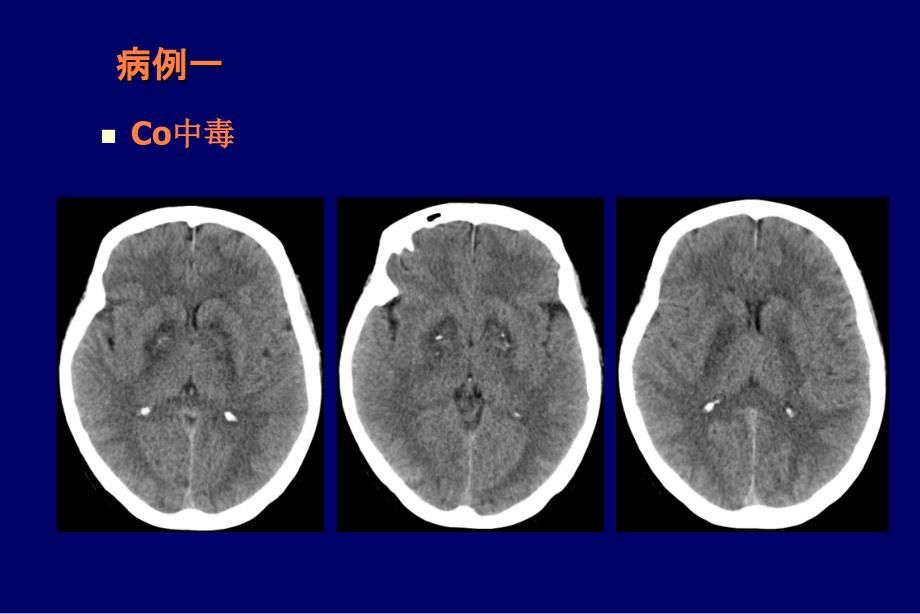 颅脑常见病变的诊断PPT课件_第2页