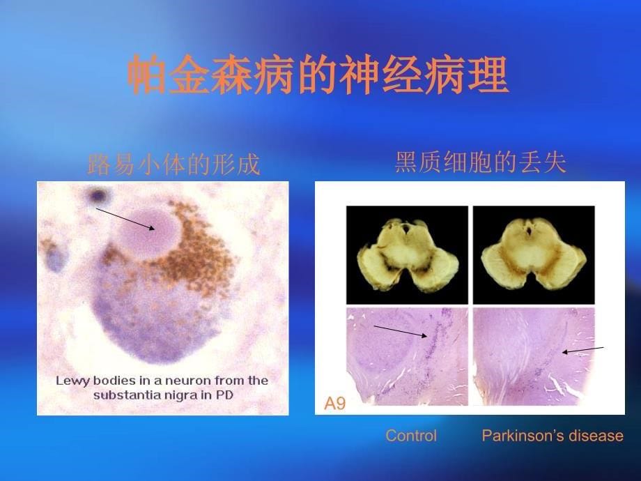 帕金森病的诊断和治疗PPT课件_第5页