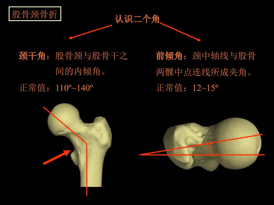 讲课股骨颈骨折课件PPT课件_第4页