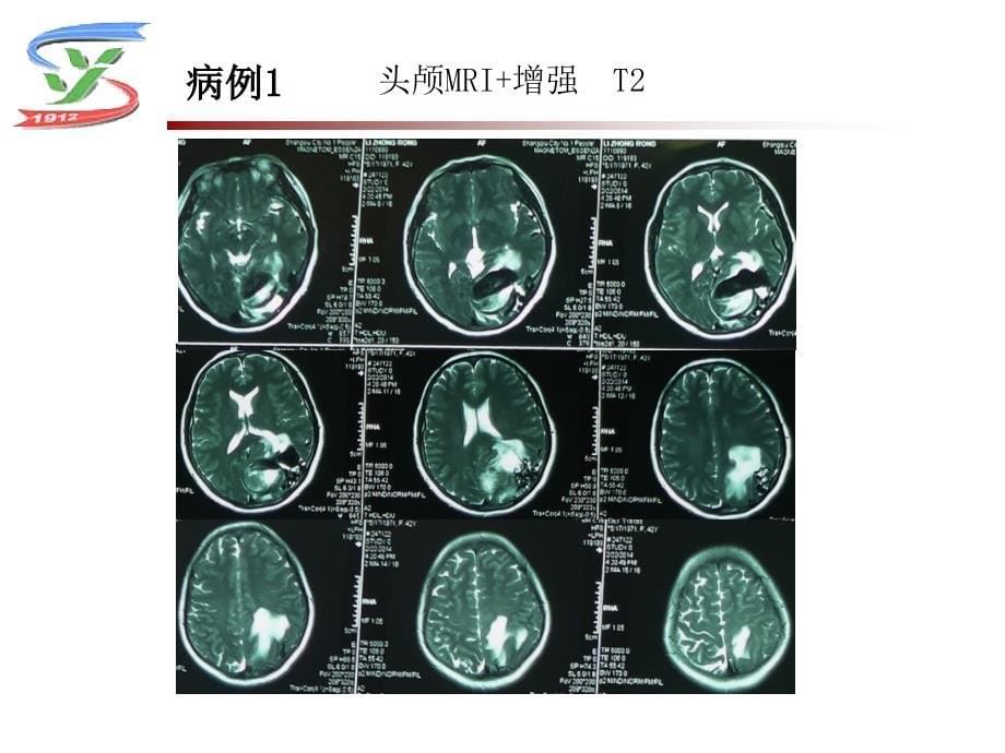 血管性耳鸣PPT课件_第5页