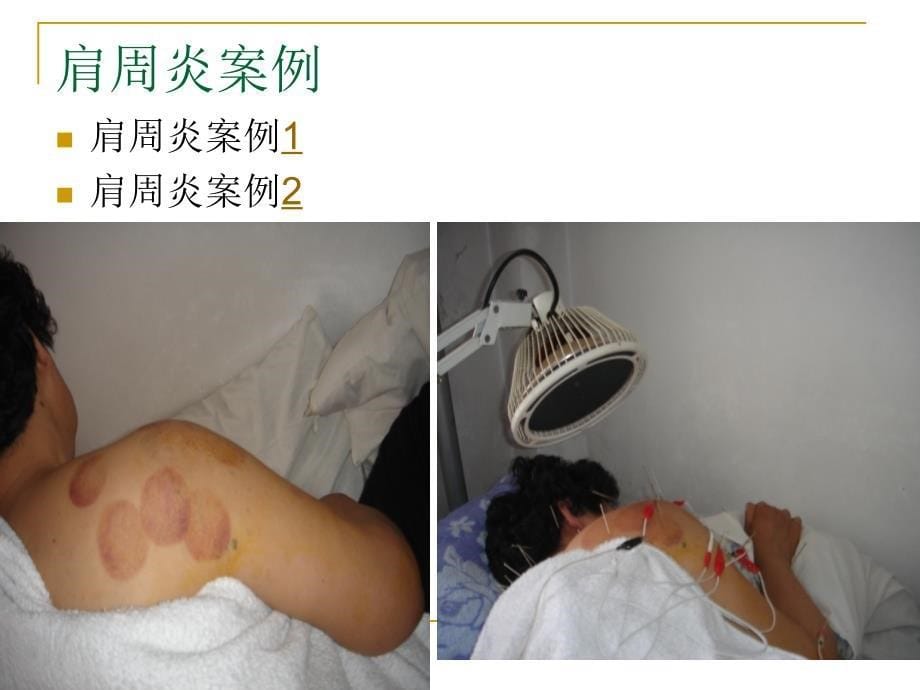 中西医结合康复治疗肩痛PPT课件_第5页