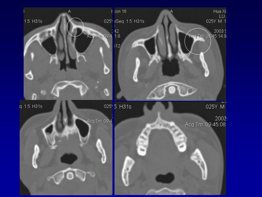 颌面部解剖及其病变的影像诊断PPT课件_第5页
