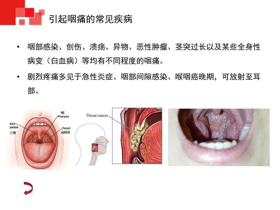 咽的症状学PPT课件_第5页