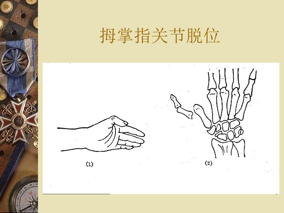 掌指关节脱位PPT课件_第3页