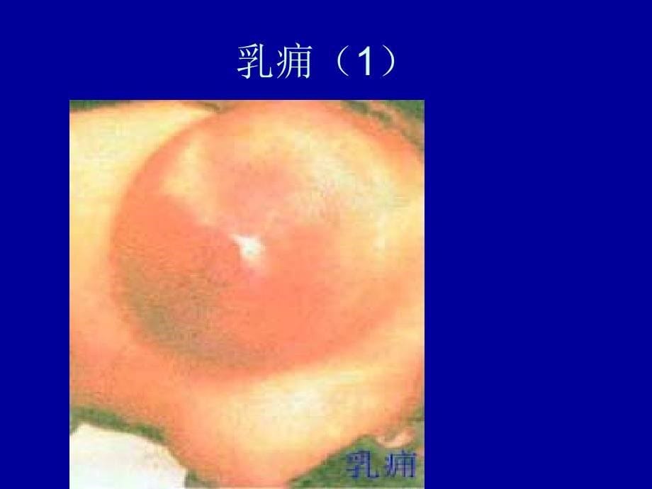 乳痈幻灯片PPT课件_第5页