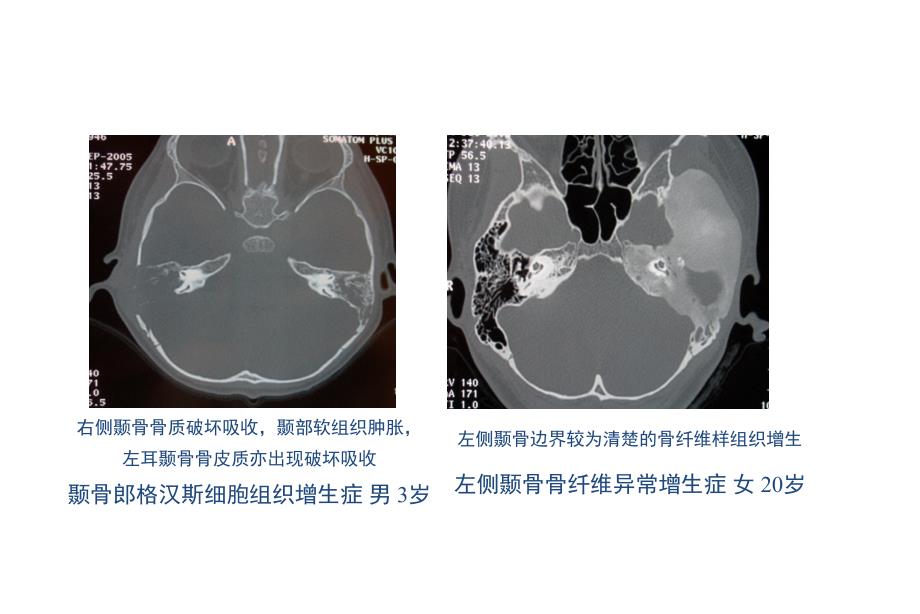 颞骨影像肉芽肿肿瘤耳硬化PPT课件_第2页