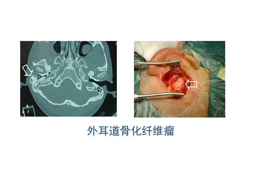 颞骨影像肉芽肿肿瘤耳硬化PPT课件_第3页