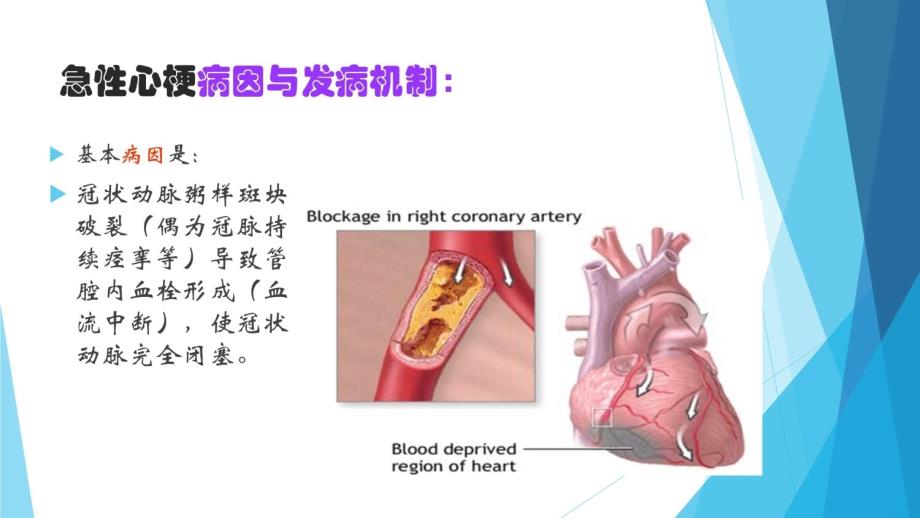 急性心梗溶栓的护理教学文案_第3页