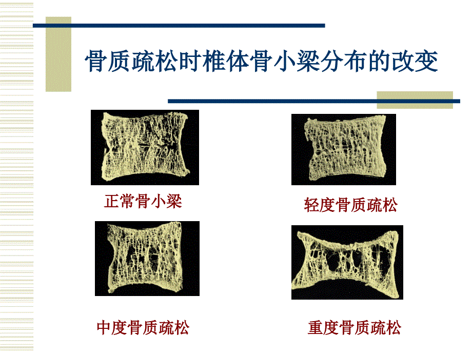 骨质疏松的规范化治疗PPT课件_第4页