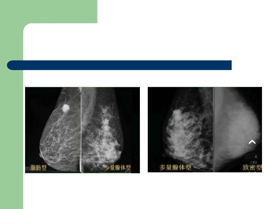 乳腺BI-RADS分级讲课资料_第4页