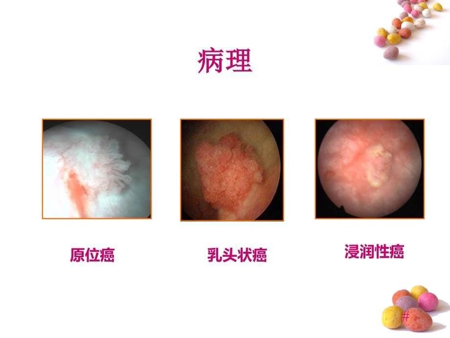 膀胱肿瘤病人的护理说课材料_第5页